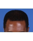 After Hair Transplant&nbsp;Front
